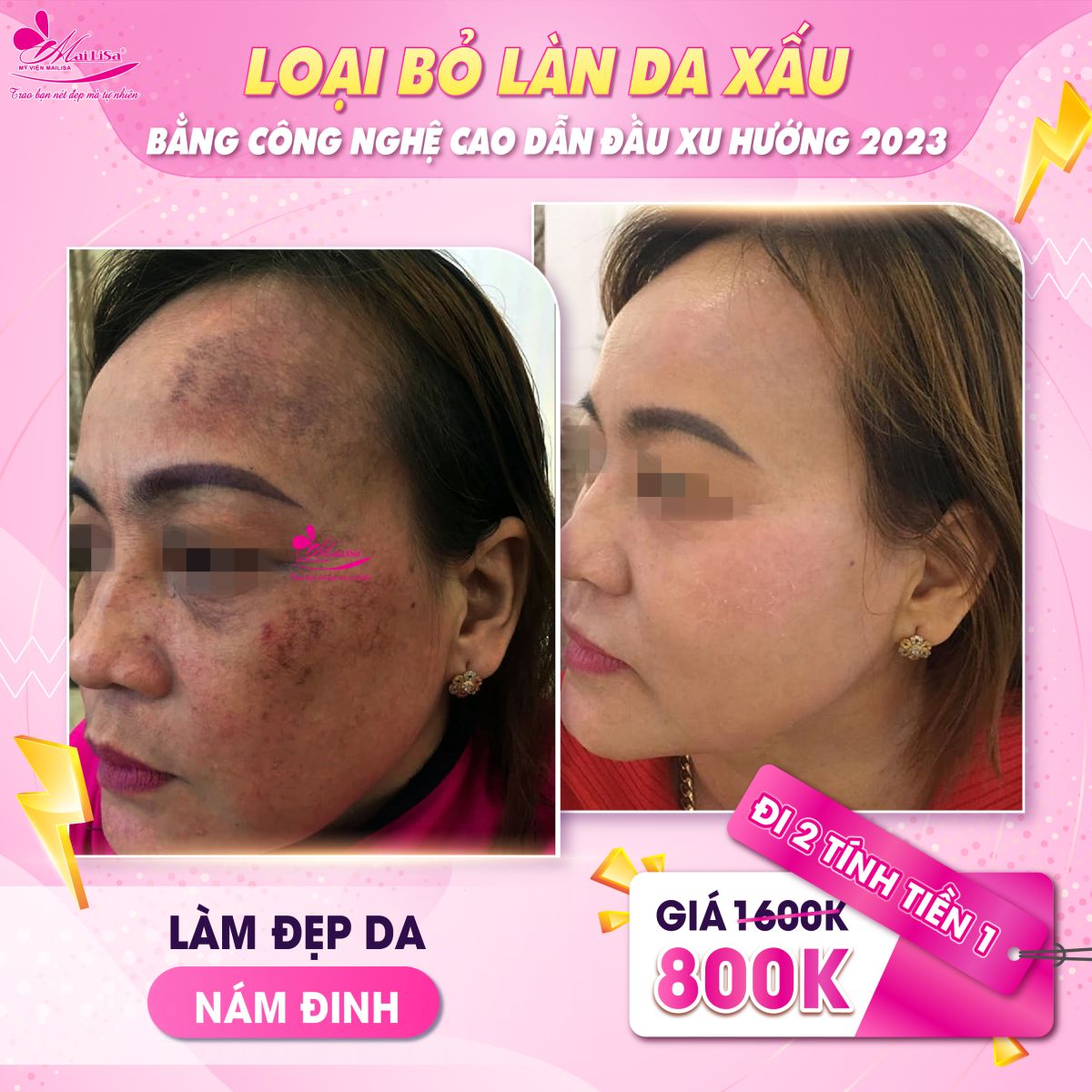 TUẦN LỄ VÀNG CHO LÀN DA XẤU - THÁNG 7 TUẦN LỄ VÀNG CHO LÀN DA XẤU - THÁNG 7