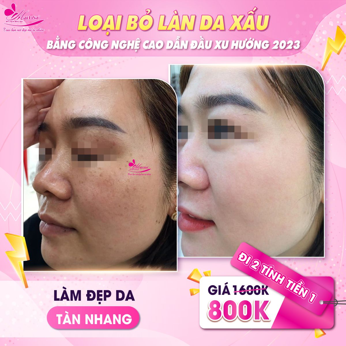 TUẦN LỄ VÀNG CHO LÀN DA XẤU - THÁNG 7 TUẦN LỄ VÀNG CHO LÀN DA XẤU - THÁNG 7