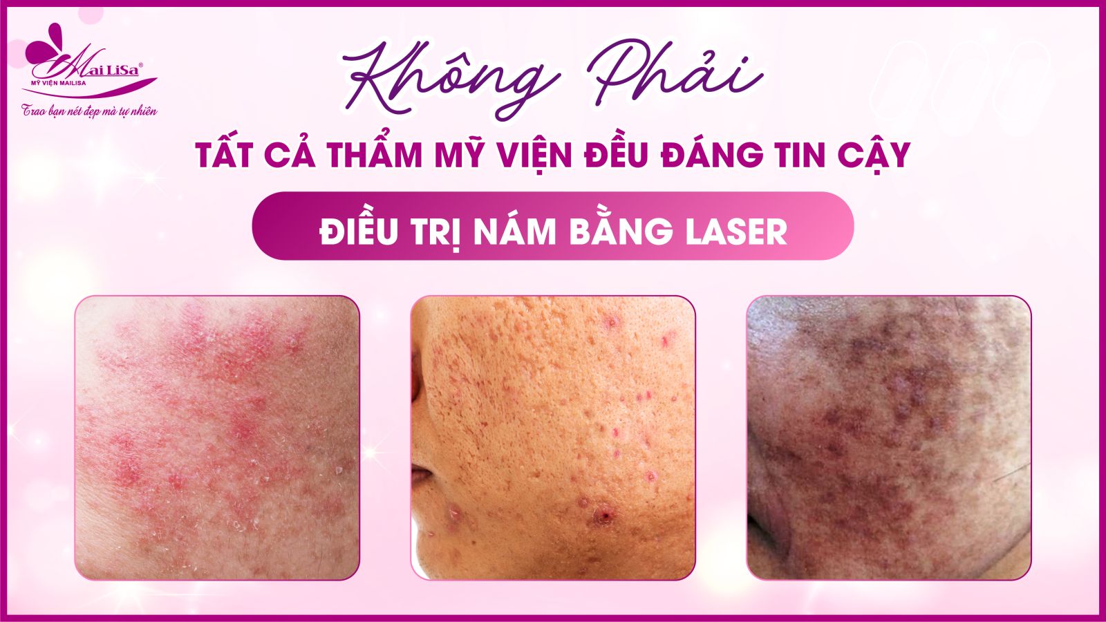 Bắn laser trị nám Whiteskin spectra có tốt không? Chi phí 2023 bắn tia laser trị tàn nhang có tốt không