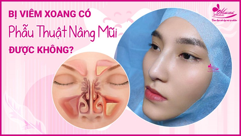 Bị viêm xoang có nâng mũi được không, có nguy hiểm không ? bị viêm xoang có nên nâng mũi không