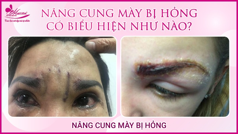 Biến chứng nghiêm trọng nâng cung mày bị hỏng 2023 mắt trợn ngược sau khi cắt treo chân mày
