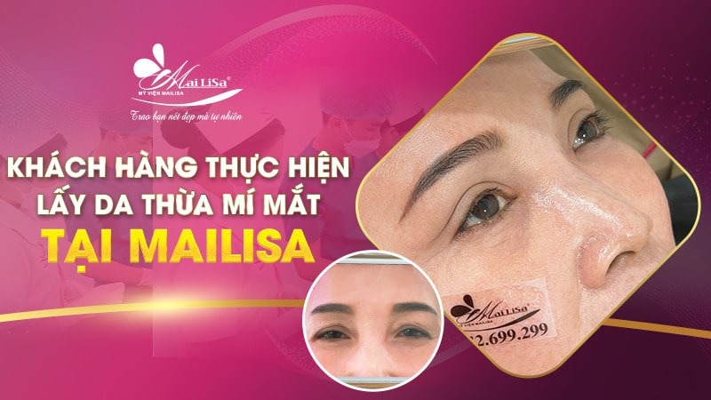 Có nên lấy mỡ mí mắt nội soi không và những điều cần tránh 16 - 16 lấy mỡ mí mắt nội soi lấy mỡ mí mắt nội soi