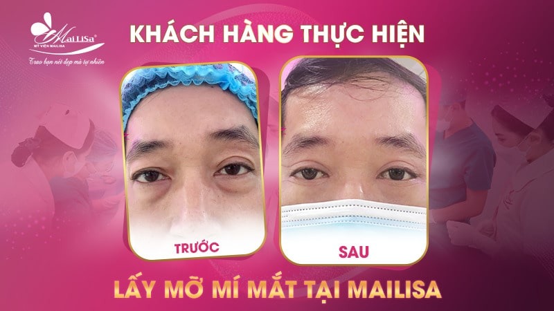 Có nên lấy mỡ mí mắt nội soi không và những điều cần tránh 13 - 13 lấy mỡ mí mắt nội soi lấy mỡ mí mắt nội soi