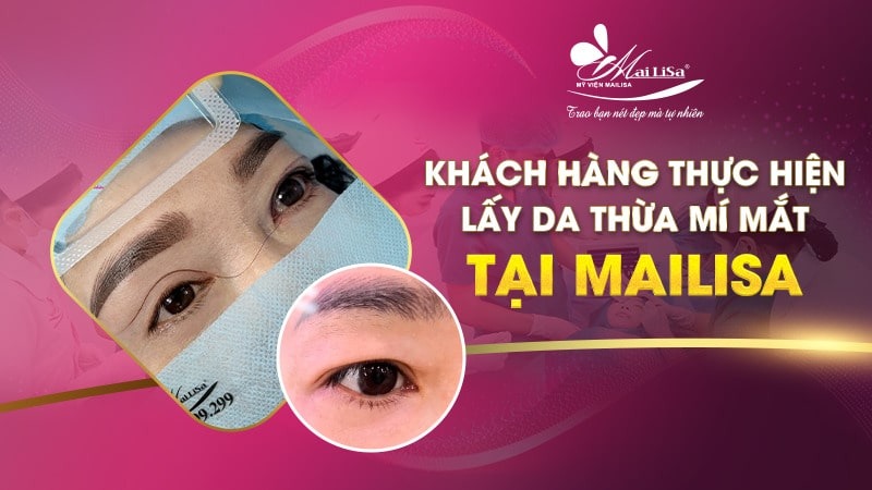 Có nên lấy mỡ mí mắt nội soi không và những điều cần tránh 14 - 14 lấy mỡ mí mắt nội soi lấy mỡ mí mắt nội soi