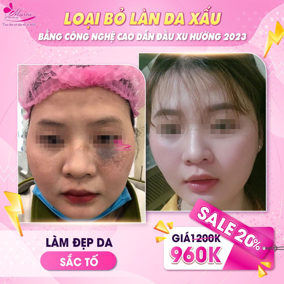 SĂN SALE KHỦNG - NHẬN QUÀ TO mừng ngày 8 tháng 3 tại Mailisa da bớt sắc tố