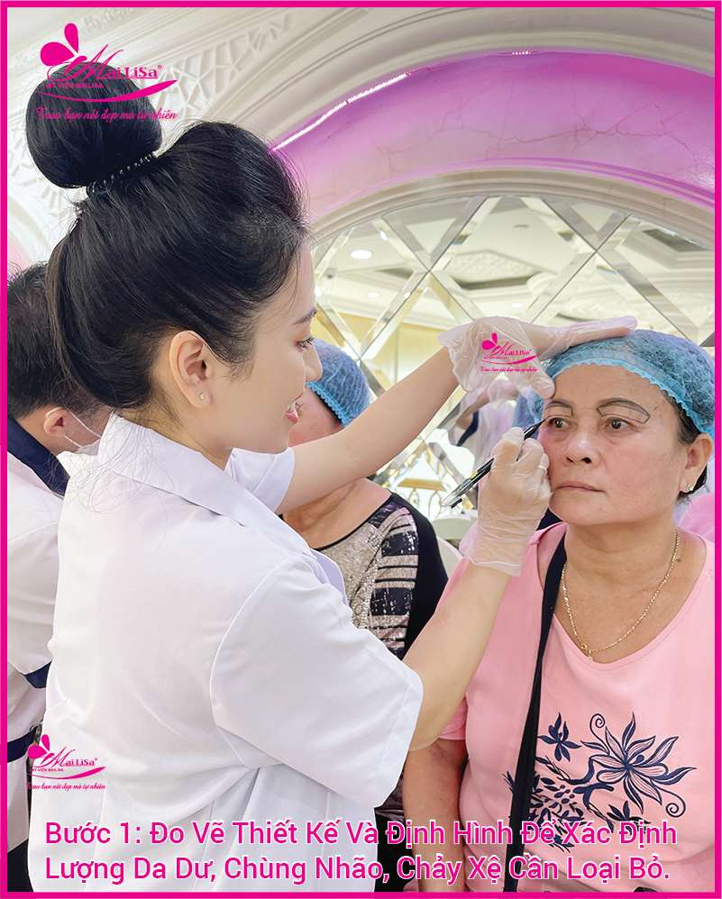 Phẫu thuật nâng cơ mí mắt là gì? Giá bao nhiêu HỢP LÝ 2023? Đo vẽ thiết kế định hình cho khách