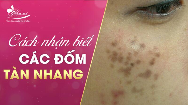 Tàn nhang bẩm sinh có chữa được không - 4 Cách chữa tàn nhang bẩm sinh 3 - 3 cách trị tàn nhang bẩm sinh cac dom tan nhang