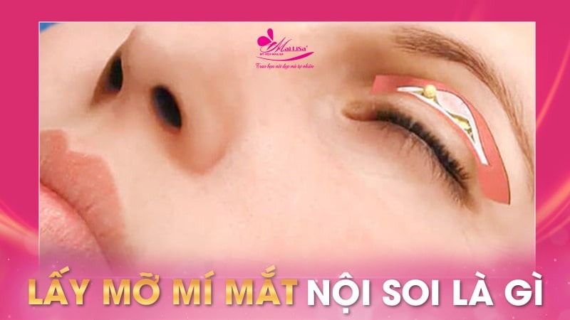 Có nên lấy mỡ mí mắt nội soi không và những điều cần tránh 2 - 2 lấy mỡ mí mắt nội soi lấy mỡ mí mắt nội soi