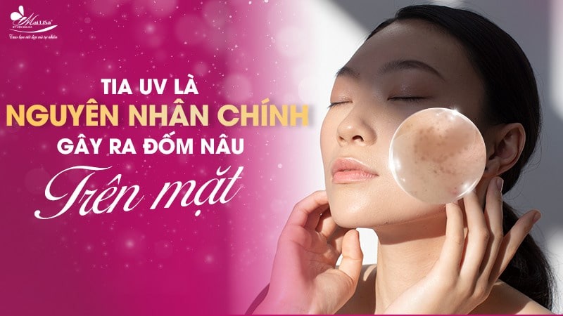 8 Cách trị đốm nâu trên mặt thịnh hành hiện nay 5 - 5 đốm nâu trên mặt cach chua tan nhang lau ngay