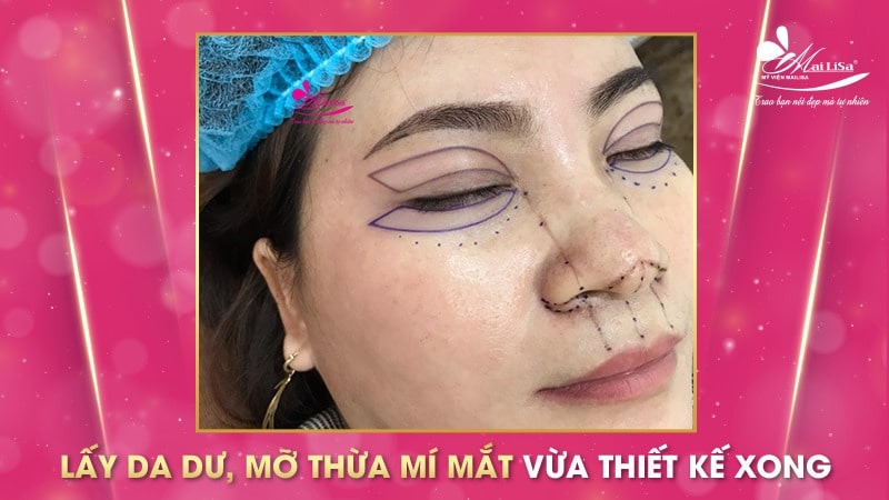 Có nên lấy mỡ mí mắt nội soi không và những điều cần tránh 10 - 10 lấy mỡ mí mắt nội soi lấy mỡ mí mắt nội soi