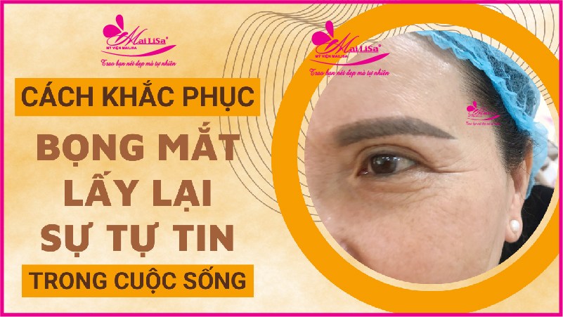 Người có bọng mắt to đẹp hay xấu? tướng số có tốt không? chữa bọng mắt to