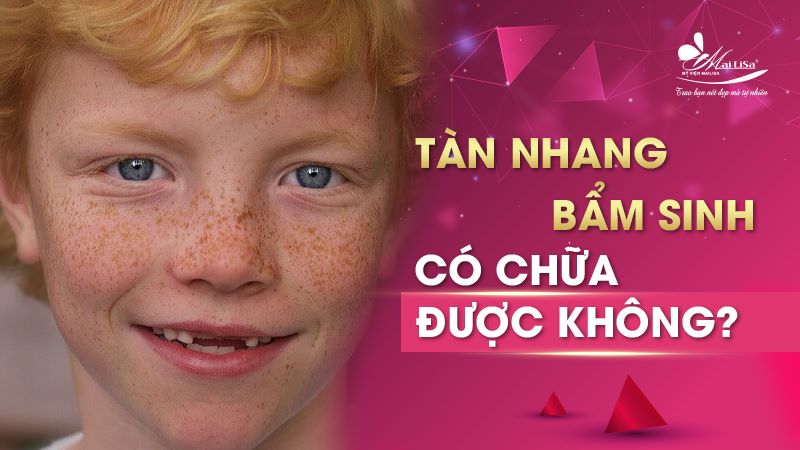 Tàn nhang bẩm sinh có chữa được không - 4 Cách chữa tàn nhang bẩm sinh 1 - 1 cách trị tàn nhang bẩm sinh cach tri tan nhang bam sinh