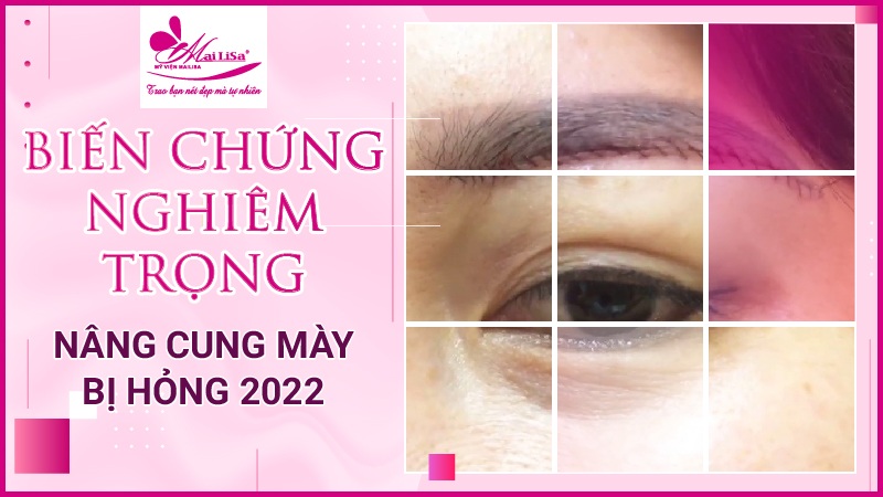 Biến chứng nghiêm trọng nâng cung mày bị hỏng 2023 nâng chân mày bị hư