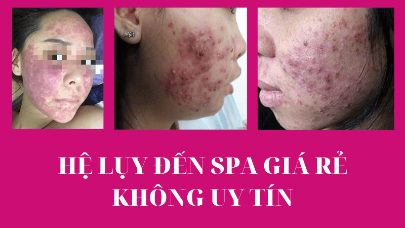 Bảng giá dịch vụ trị thâm mụn ở spa giá bao nhiêu 2022? hệ lụy nghiêm trọng khi đến spa giá rẻ không uy tín