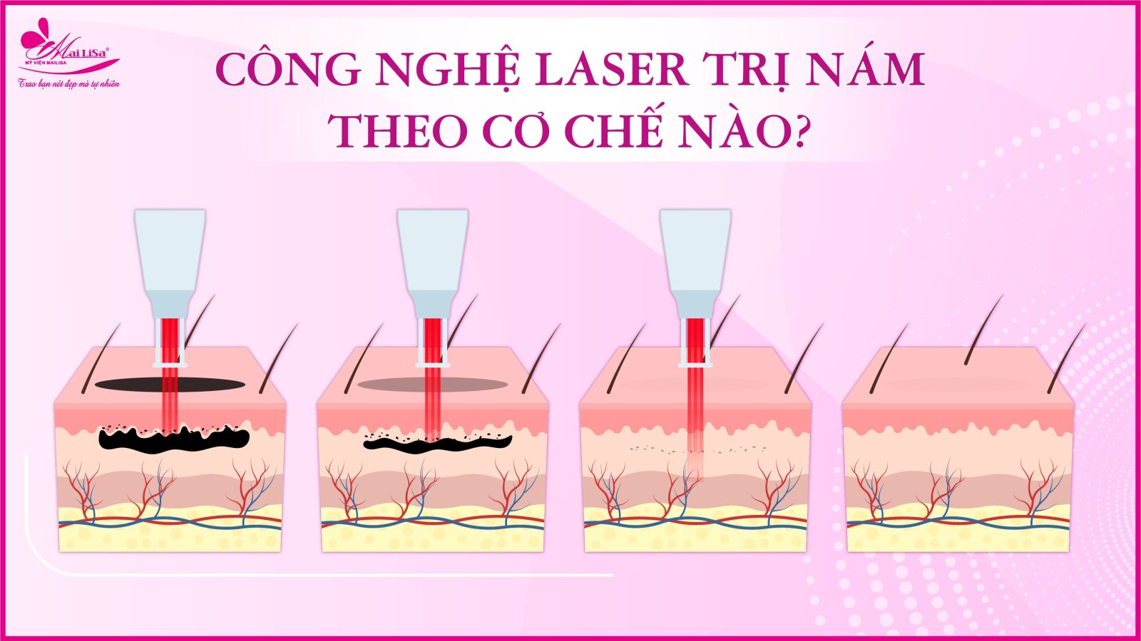 Bắn laser trị nám Whiteskin spectra có tốt không? Chi phí 2023 Bắn laser trị nám Whiteskin spectra có tốt không? Chi phí 2023