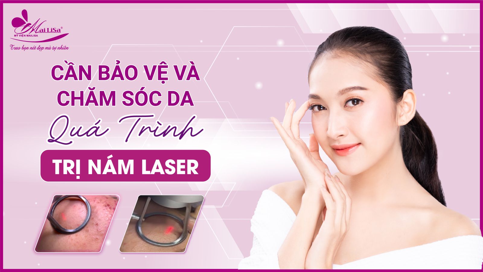 Bắn laser trị nám Whiteskin spectra có tốt không? Chi phí 2023 Bắn laser trị nám Whiteskin spectra có tốt không? Chi phí 2023