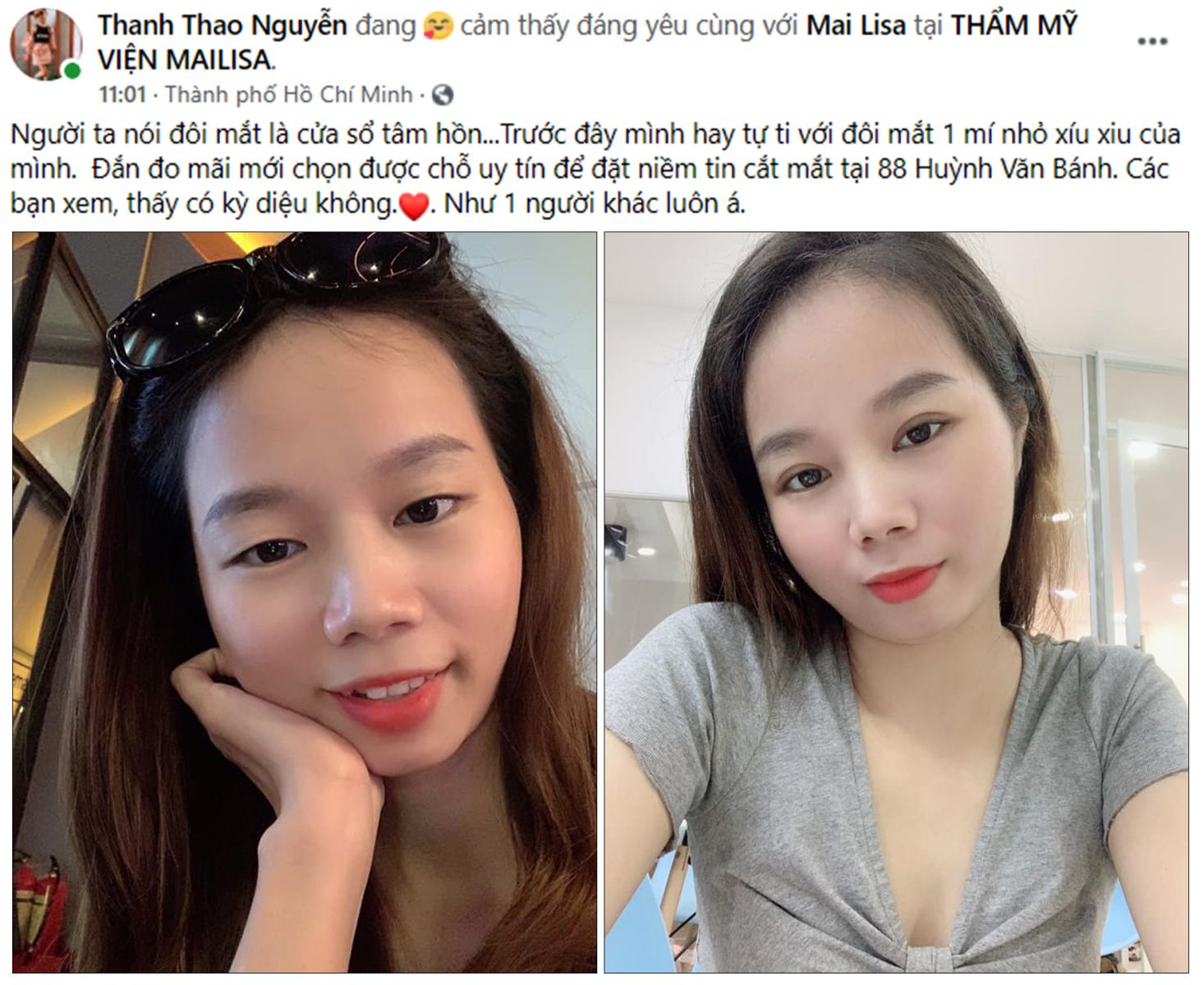 Phẫu thuật tạo hình mắt 2 mí Perfect Line Phẫu thuật tạo hình mắt 2 mí Perfect Line