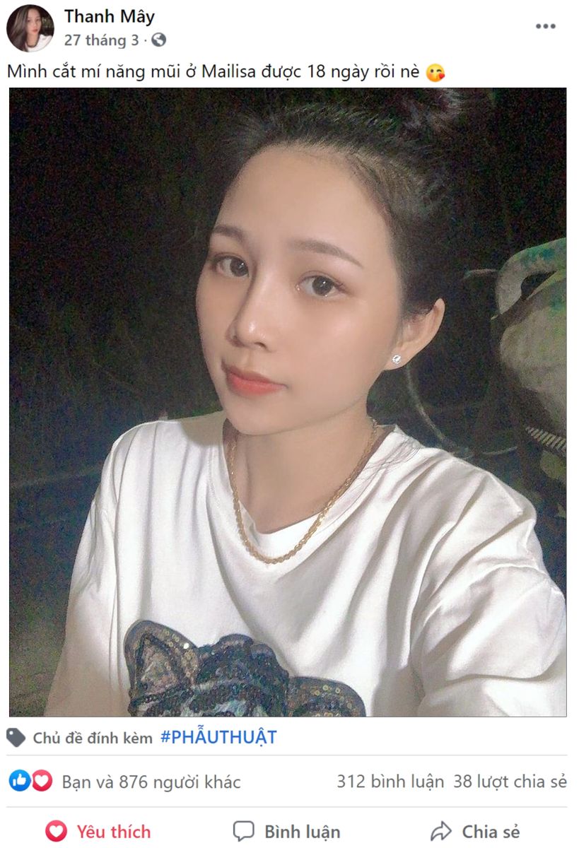 Phẫu thuật tạo hình mắt 2 mí Perfect Line Phẫu thuật tạo hình mắt 2 mí Perfect Line