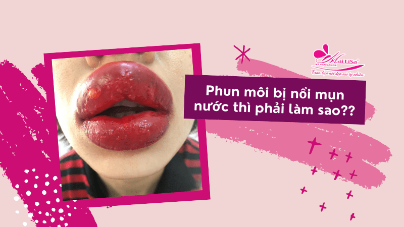 Hướng dẫn cách chăm sóc, dưỡng môi sau khi xăm, phun HIỆU QUẢ 2021 phun môi bị nổi mụn nước phải làm sao
