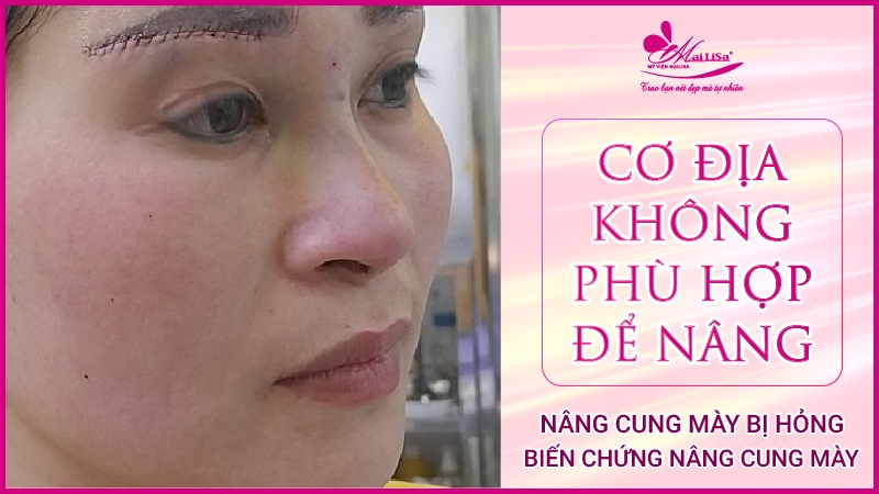 Biến chứng nghiêm trọng nâng cung mày bị hỏng 2023 Nâng cung chân mày bị sưng