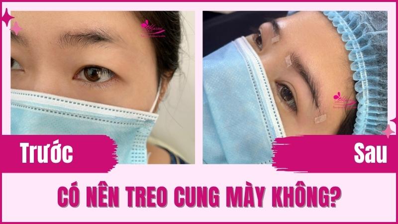 Biến chứng nghiêm trọng nâng cung mày bị hỏng 2023 Treo chân mày nội soi