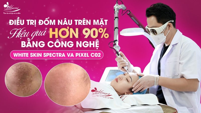 8 Cách trị đốm nâu trên mặt thịnh hành hiện nay 17 - 17 đốm nâu trên mặt da co dom nau