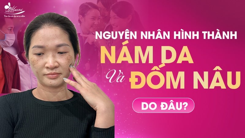 8 Cách trị đốm nâu trên mặt thịnh hành hiện nay 3 - 3 đốm nâu trên mặt da xuat hien dom nau
