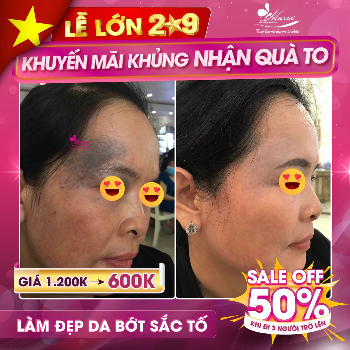 SĂN SALE KHỦNG da bớt sắc tố