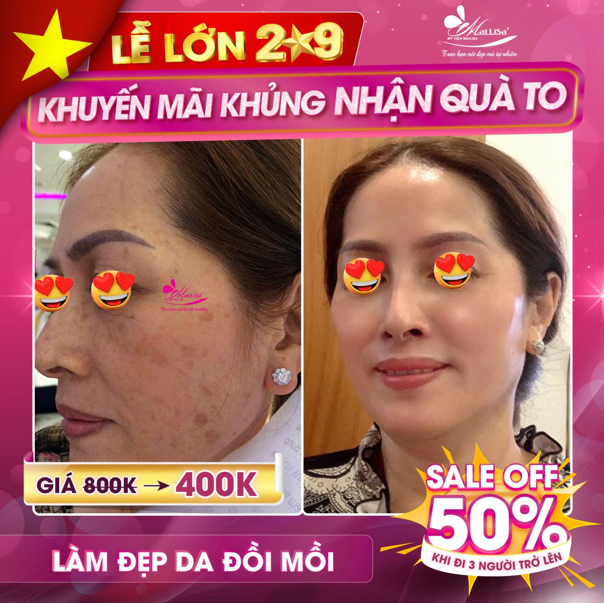 SĂN SALE KHỦNG - da sẹo rỗ