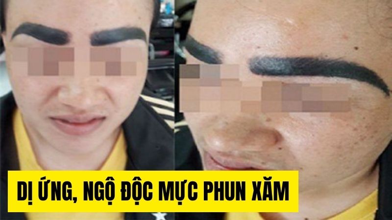 Phun xăm lông mày, môi có ảnh hưởng gì không? Có hại không? Có nguy hiểm không? Hình ảnh dị ứng ngộ độc mực xăm chân mày