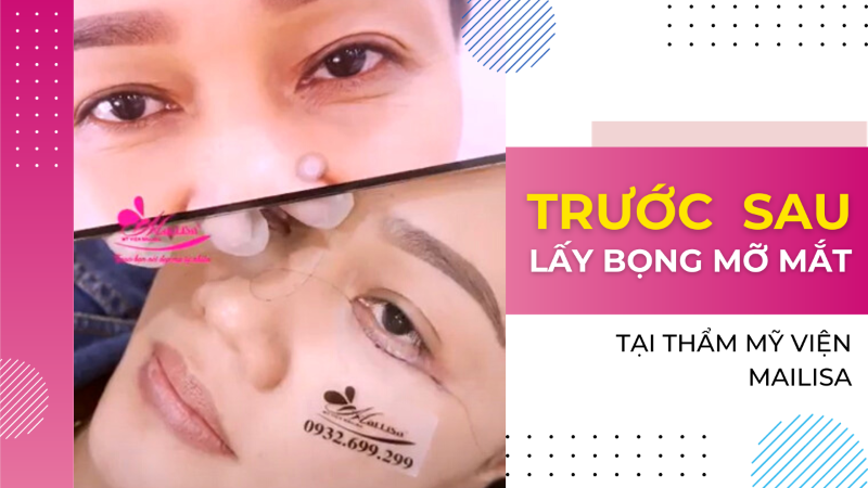 Thẩm mỹ viện Mailisa lừa đảo ? Sự thật ĐAU LÒNG trong ngành THẨM MỸ VIỆN 2023 Thẩm mỹ viện Mailisa lừa đảo ? Sự thật ĐAU LÒNG trong ngành THẨM MỸ VIỆN 2023