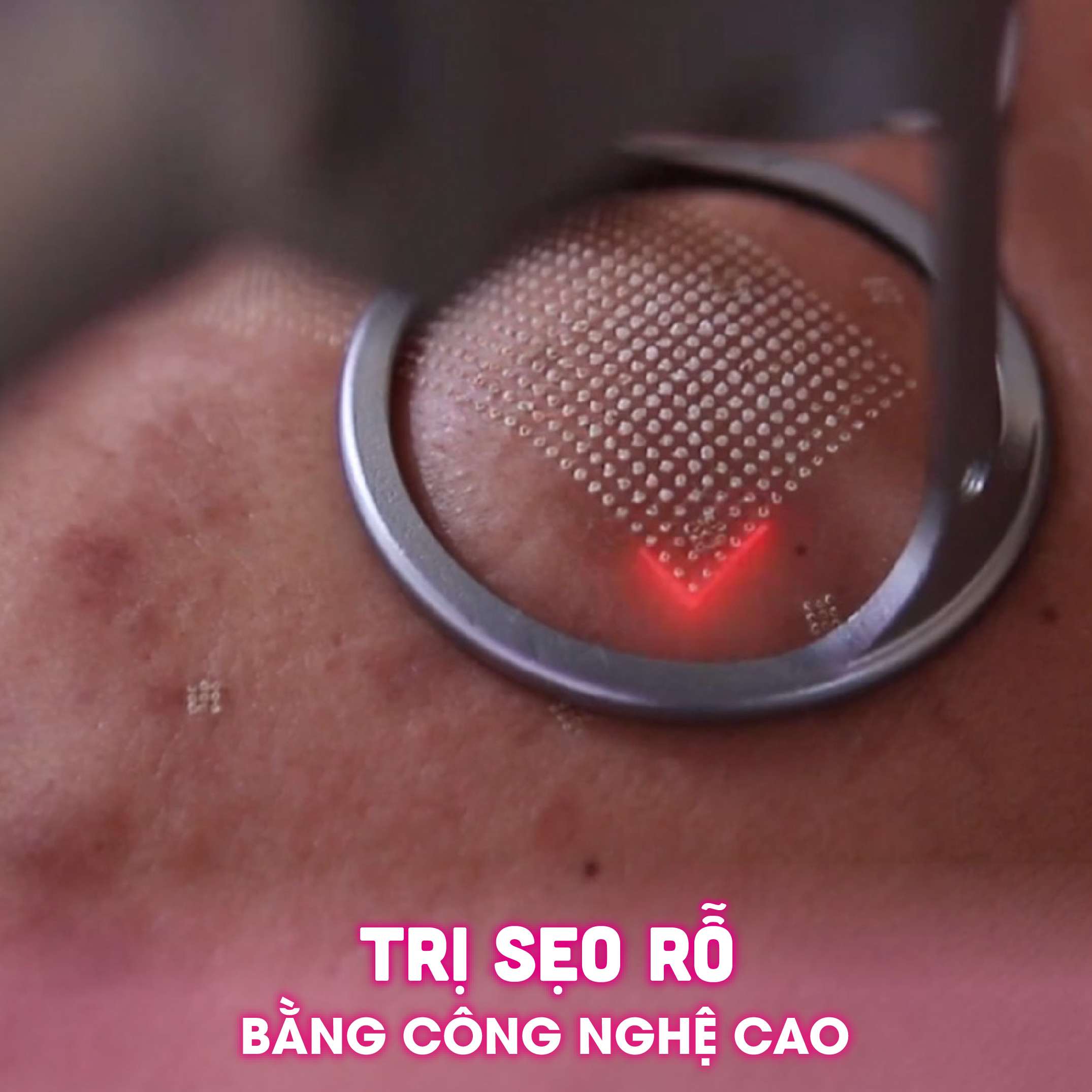 dieu-tri-seo-ro-lau-nam-bang-cong-nghe-cao-0-784 Làm đẹp da sẹo rỗ bằng công nghệ cao