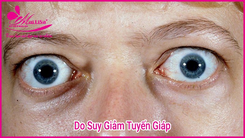 Phẫu thuật nâng cơ mí mắt là gì? Giá bao nhiêu HỢP LÝ 2023? Do suy giảm tuyến giáp