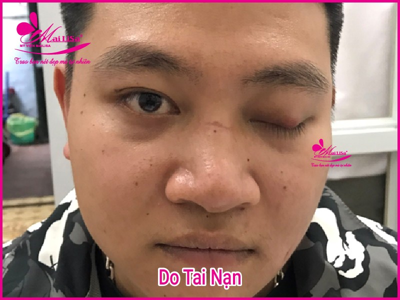 Phẫu thuật nâng cơ mí mắt là gì? Giá bao nhiêu HỢP LÝ 2023? Do tai nạn