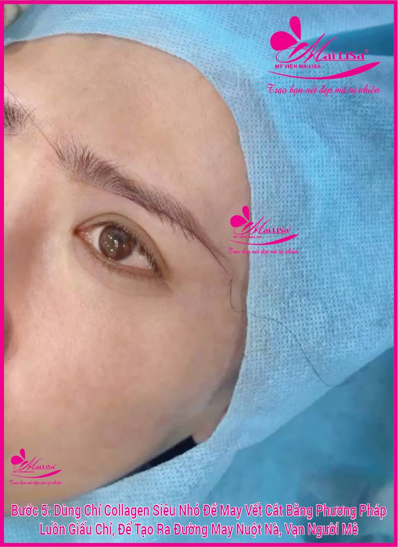 Phẫu thuật nâng cơ mí mắt là gì? Giá bao nhiêu HỢP LÝ 2023? Dùng chỉ collagen siêu nhỏ để may