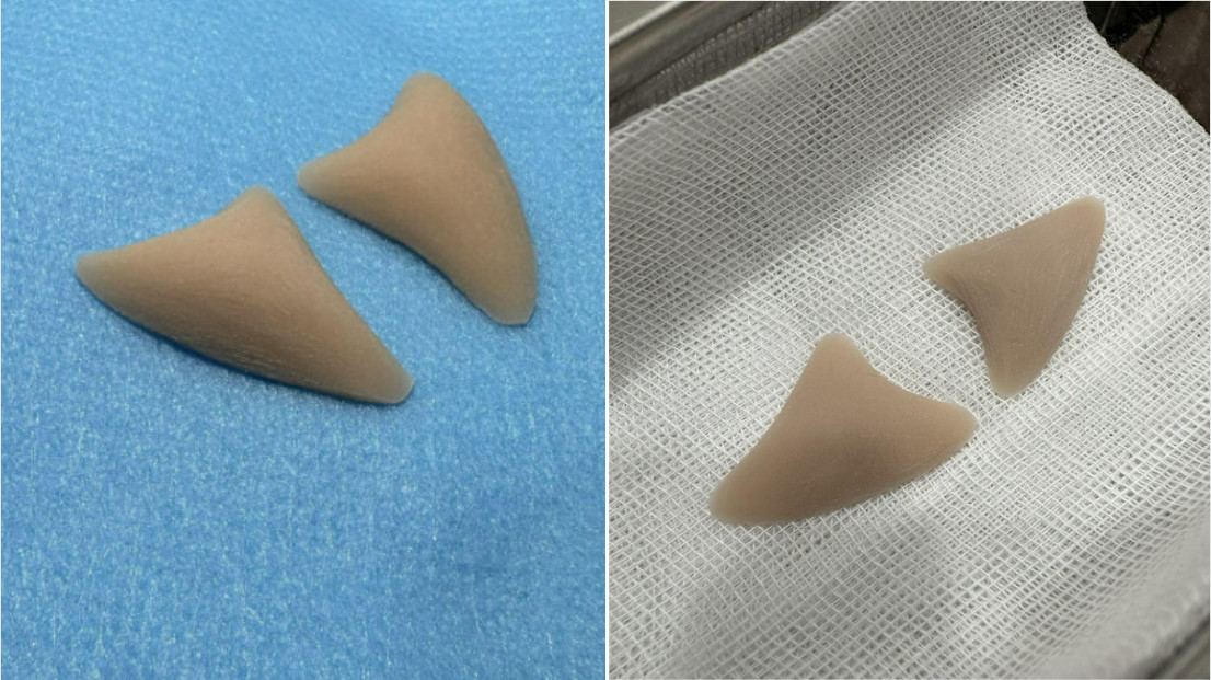 Làm đầy rãnh cười Babies line vật liệu làm đầy rãnh cười