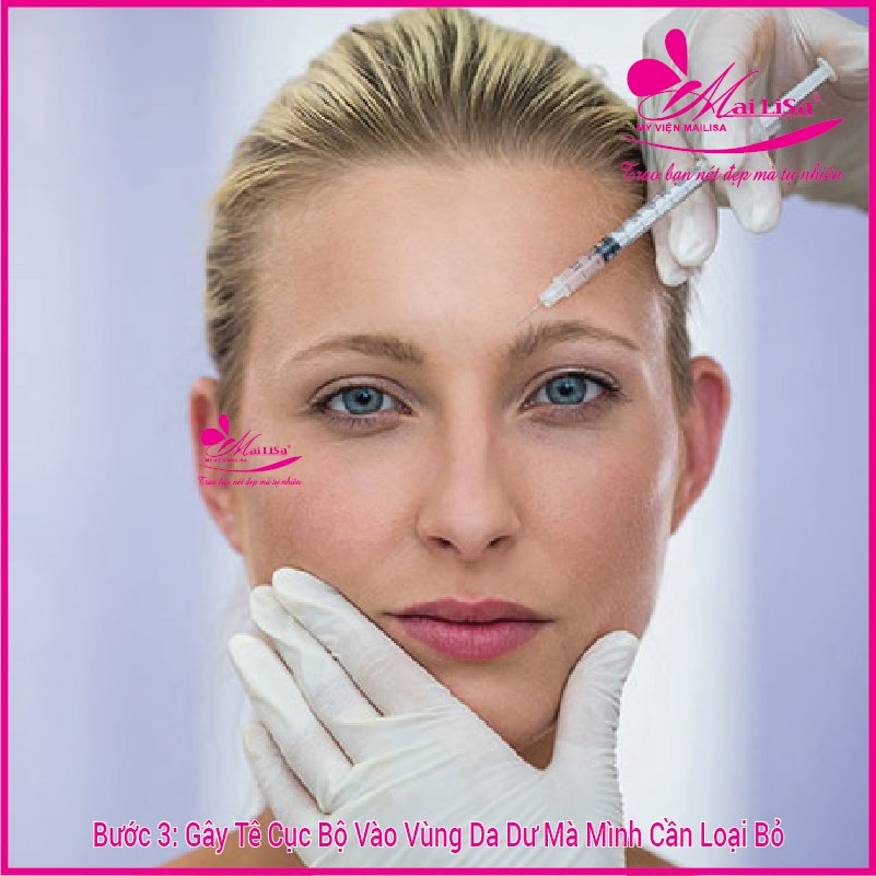 Phẫu thuật nâng cơ mí mắt là gì? Giá bao nhiêu HỢP LÝ 2023? Gây tê cục bộ vùng da dư cần bỏ