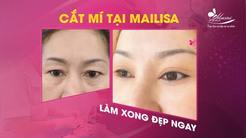Có nên lấy mỡ mí mắt nội soi không và những điều cần tránh 8 - 8 lấy mỡ mí mắt nội soi lấy mỡ mí mắt nội soi