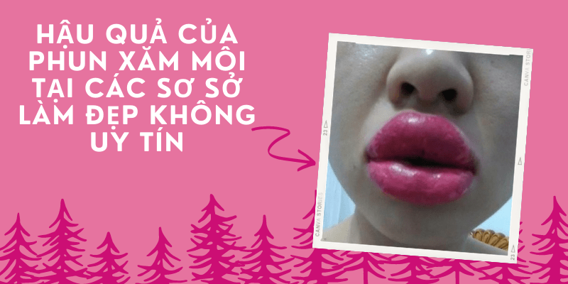 Tác hại của việc phun xăm môi tại địa chỉ KHÔNG UY TÍN năm 2021 tác hại, hậu quả của việc phun xăm môi