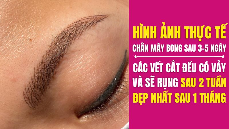Lông mày điêu khắc là gì? RỦI RO khi điêu khắc chân mày nam nữ Hình ảnh bong tróc lông mày điêu khắc