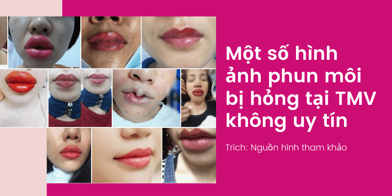 Phun xăm môi bị thâm phải làm sao? Cách khắc phục HIỆU QUẢ 2021 Hình ảnh phun môi bị hỏng