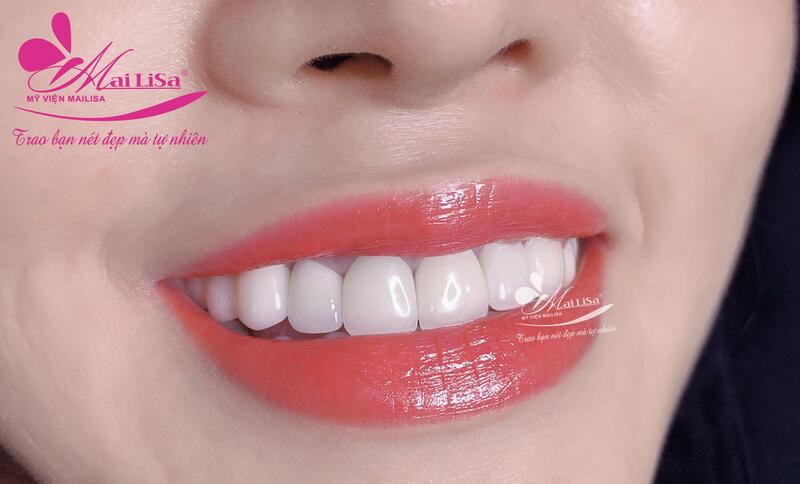 Phun môi hiệu ứng son lì 3D Mailisa: Có nên phun môi không? Phun môi ở mailisa giá bao nhiêu? hình ảnh phun xăm môi mailisa