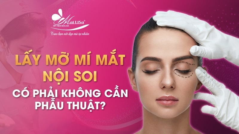 Có nên lấy mỡ mí mắt nội soi không và những điều cần tránh 3 - 3 lấy mỡ mí mắt nội soi lấy mỡ mí mắt nội soi