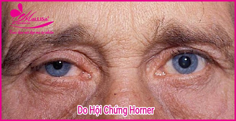 Phẫu thuật nâng cơ mí mắt là gì? Giá bao nhiêu HỢP LÝ 2023? Hội chứng Horner