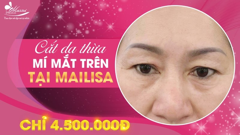 Có nên lấy mỡ mí mắt nội soi không và những điều cần tránh 11 - 11 lấy mỡ mí mắt nội soi lấy mỡ mí mắt nội soi