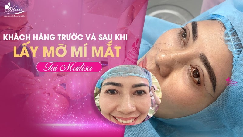 Lấy mỡ mí mắt trên bao nhiêu tiền? Dịch vụ ở đâu tốt 13 - 13 lấy mỡ mí mắt trên bao nhiêu tiền hut mo mi mat tren