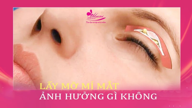 Lấy mỡ mí mắt trên bao nhiêu tiền? Dịch vụ ở đâu tốt 8 - 8 lấy mỡ mí mắt trên bao nhiêu tiền hut mo mi mat