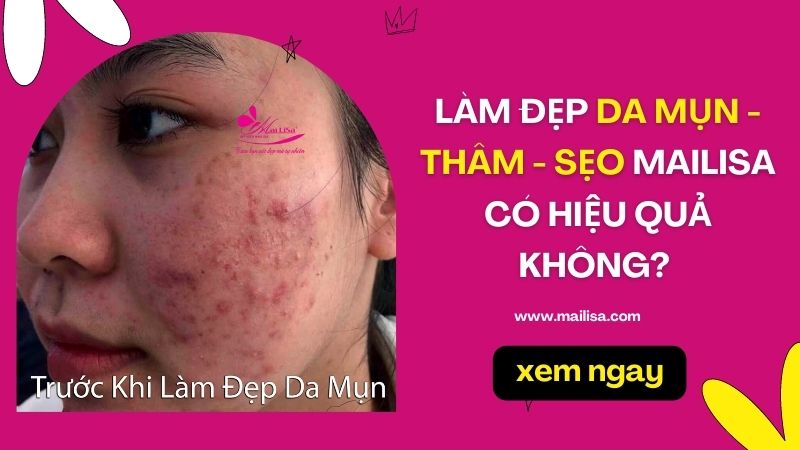 Thẩm mỹ viện Mailisa có lừa đảo khách hàng? THỰC HƯ CÁC TIN ĐỒN trong ngành THẨM MỸ thực hư dịch vụ mailisa có tốt không