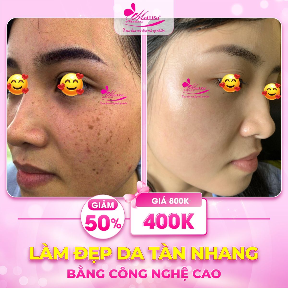 Phốt Mailisa Sự Thật Đằng Sau làm đẹp da tàn nhang công nghệ cao