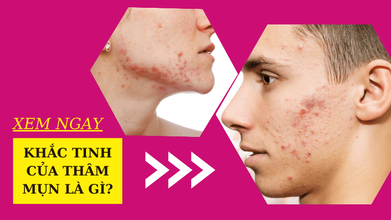 Bảng giá dịch vụ trị thâm mụn ở spa giá bao nhiêu 2022? laser là khắc tinh của thâm mụn